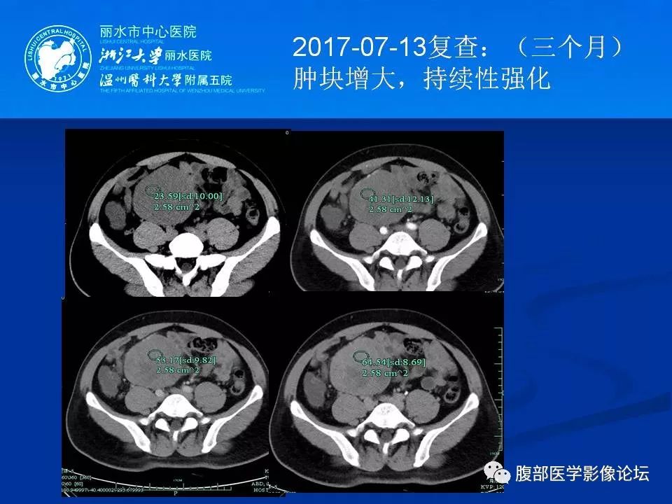 【病例】小肠系膜纤维瘤病1例CT