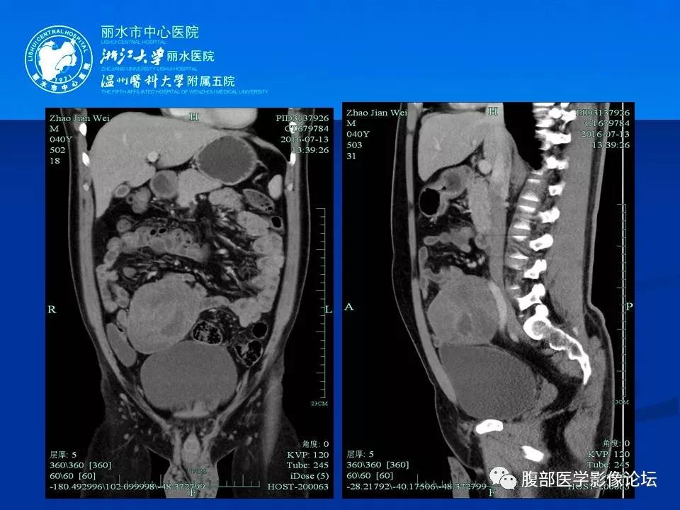 【病例】小肠系膜纤维瘤病1例CT