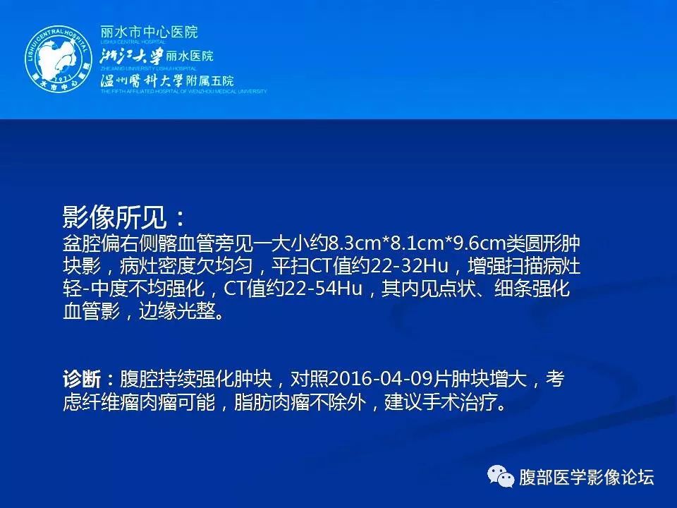 【病例】小肠系膜纤维瘤病1例CT