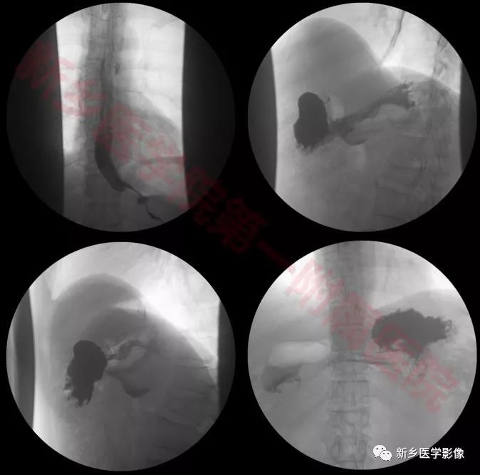 【病例】环状胰腺1例X线造影CT一例 【病例】环状胰腺1例X线造影CT一例