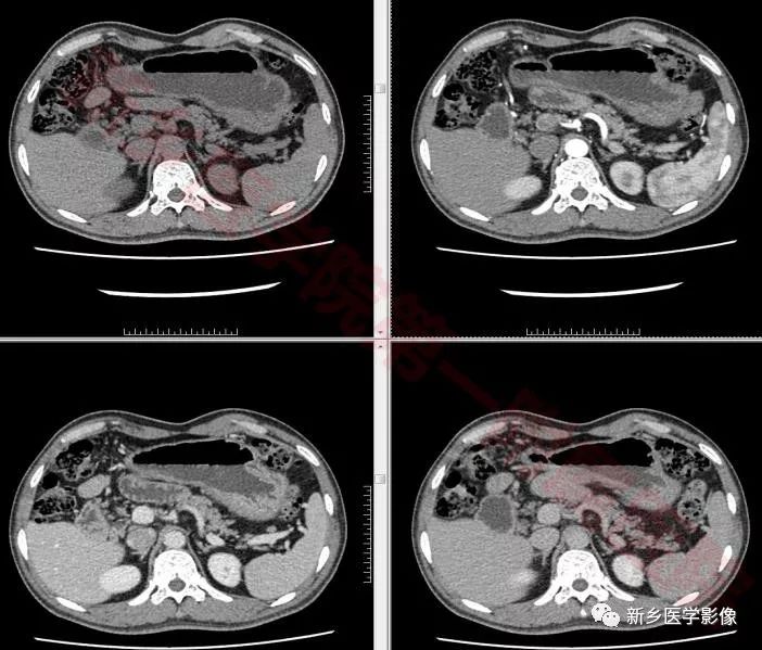 【病例】环状胰腺1例X线造影CT一例 【病例】环状胰腺1例X线造影CT一例
