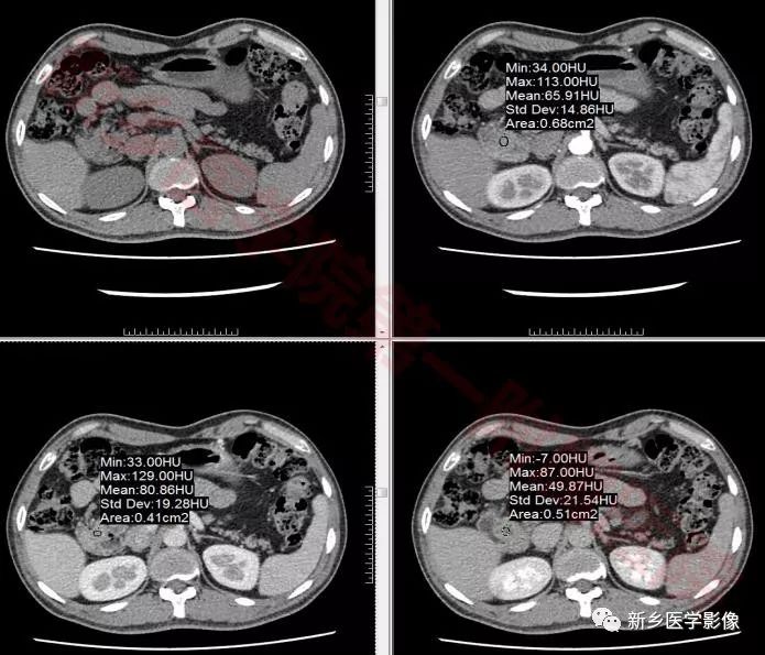【病例】环状胰腺1例X线造影CT一例 【病例】环状胰腺1例X线造影CT一例