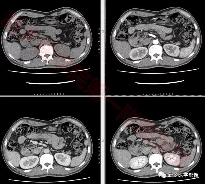 【病例】环状胰腺1例X线造影CT一例 【病例】环状胰腺1例X线造影CT一例