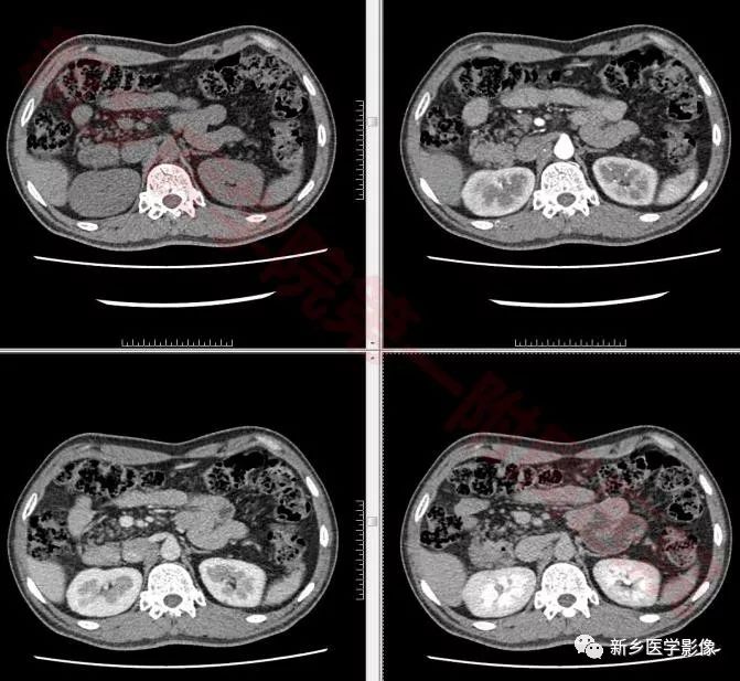 【病例】环状胰腺1例X线造影CT一例 【病例】环状胰腺1例X线造影CT一例