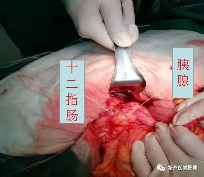 【病例】环状胰腺1例X线造影CT一例 【病例】环状胰腺1例X线造影CT一例