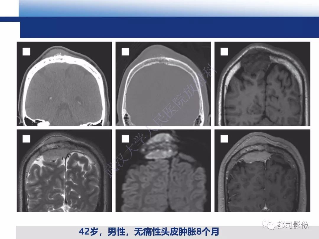 【病例】板障型脑膜瘤1例CT及MR影像诊断