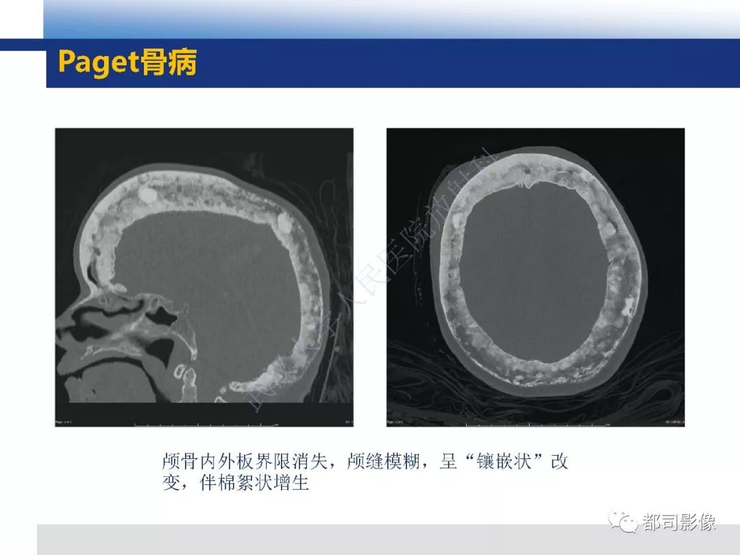 【病例】板障型脑膜瘤1例CT及MR影像诊断