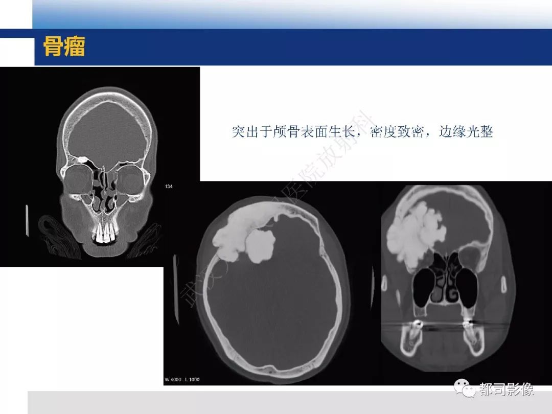 【病例】板障型脑膜瘤1例CT及MR影像诊断