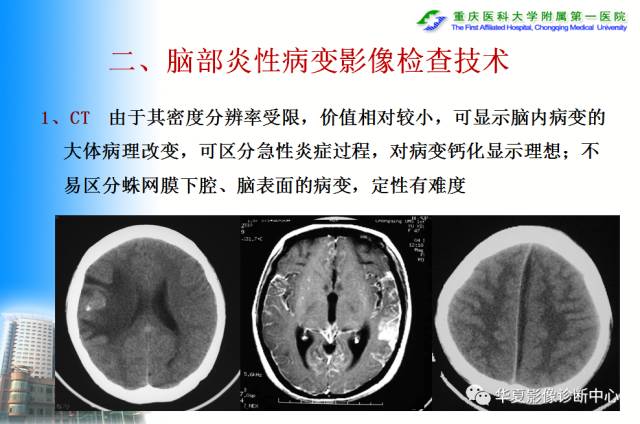 【PPT】自身免疫性脑病的影像学诊断