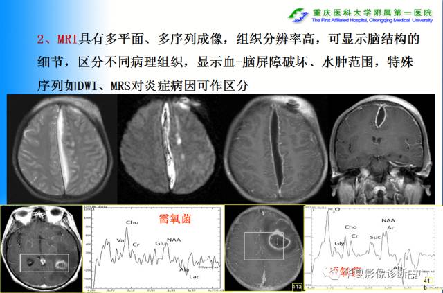 【PPT】自身免疫性脑病的影像学诊断