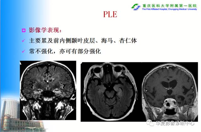 【PPT】自身免疫性脑病的影像学诊断