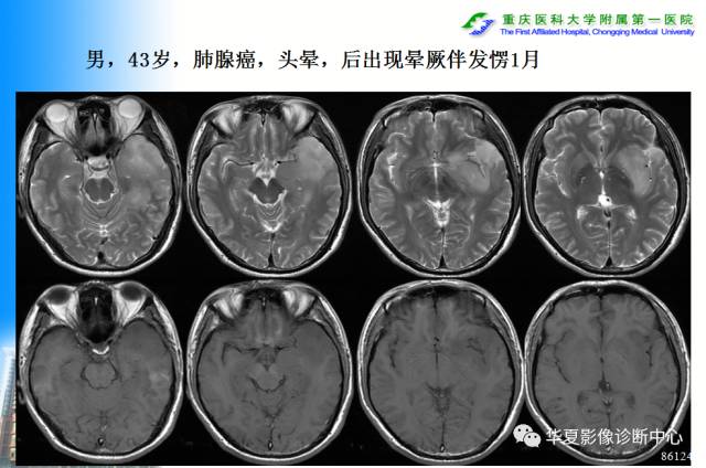 【PPT】自身免疫性脑病的影像学诊断