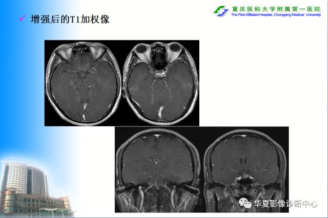 【PPT】自身免疫性脑病的影像学诊断