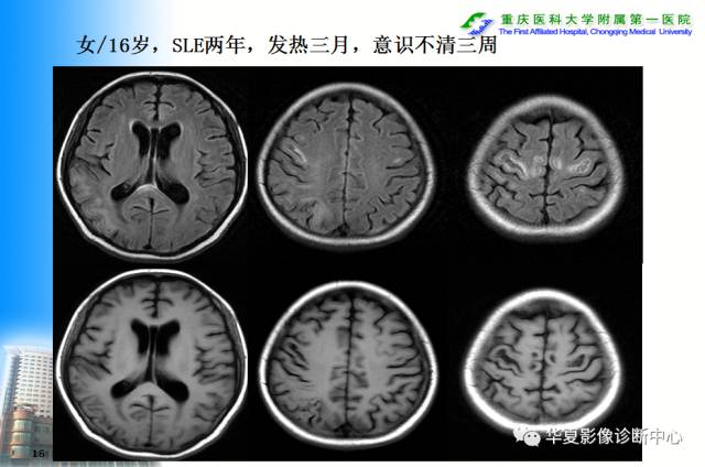 【PPT】自身免疫性脑病的影像学诊断