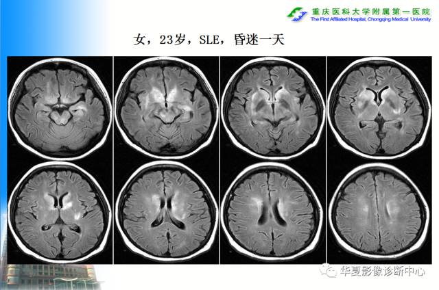 【PPT】自身免疫性脑病的影像学诊断