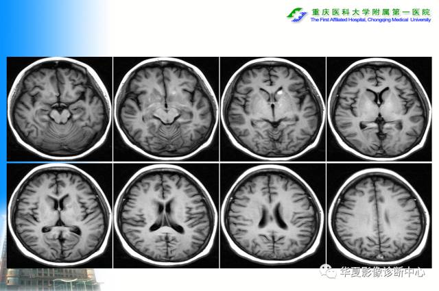 【PPT】自身免疫性脑病的影像学诊断