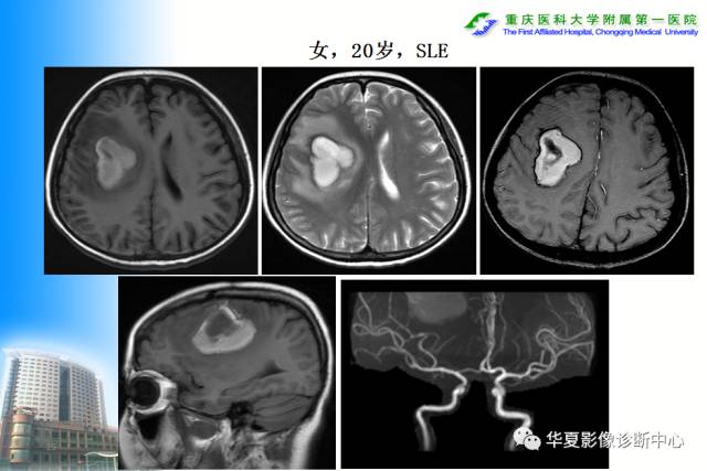 【PPT】自身免疫性脑病的影像学诊断