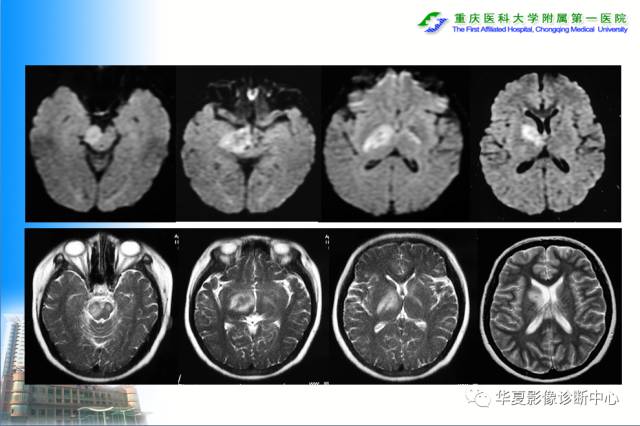 【PPT】自身免疫性脑病的影像学诊断