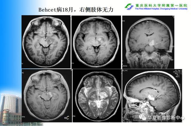 【PPT】自身免疫性脑病的影像学诊断