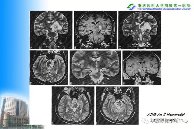 【PPT】自身免疫性脑病的影像学诊断