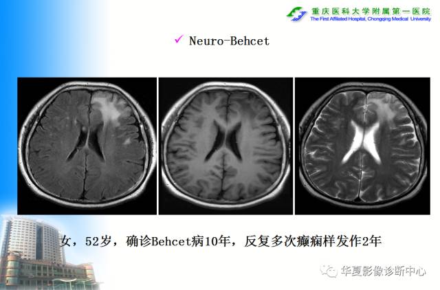 【PPT】自身免疫性脑病的影像学诊断