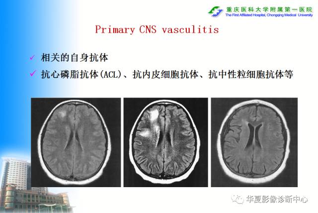 【PPT】自身免疫性脑病的影像学诊断