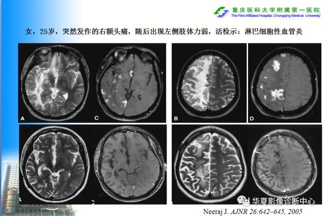 【PPT】自身免疫性脑病的影像学诊断
