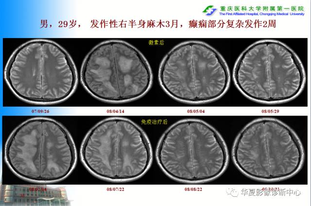 【PPT】自身免疫性脑病的影像学诊断
