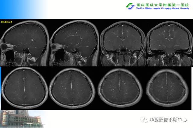 【PPT】自身免疫性脑病的影像学诊断