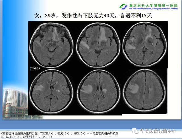 【PPT】自身免疫性脑病的影像学诊断