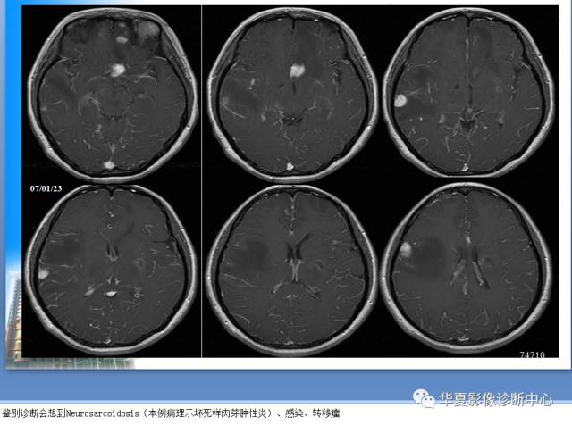 【PPT】自身免疫性脑病的影像学诊断