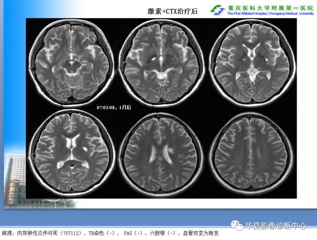 【PPT】自身免疫性脑病的影像学诊断