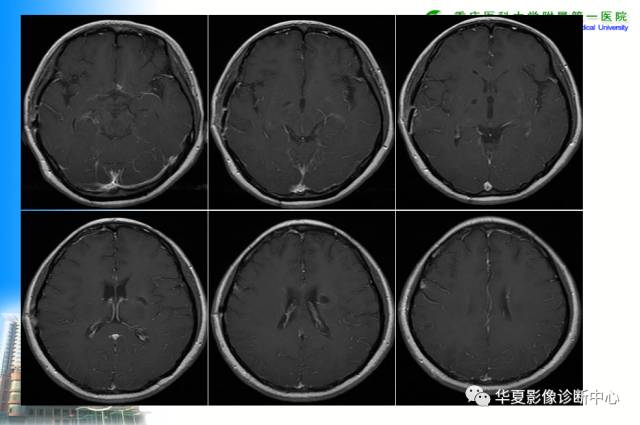 【PPT】自身免疫性脑病的影像学诊断