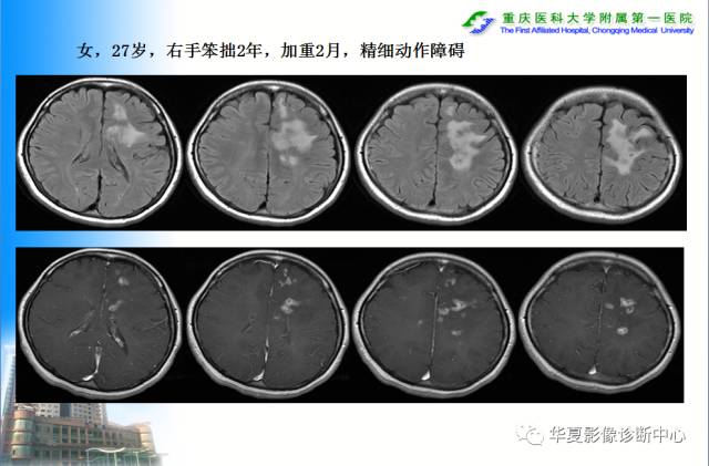 【PPT】自身免疫性脑病的影像学诊断
