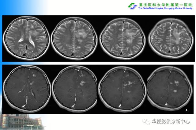 【PPT】自身免疫性脑病的影像学诊断