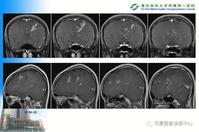 【PPT】自身免疫性脑病的影像学诊断
