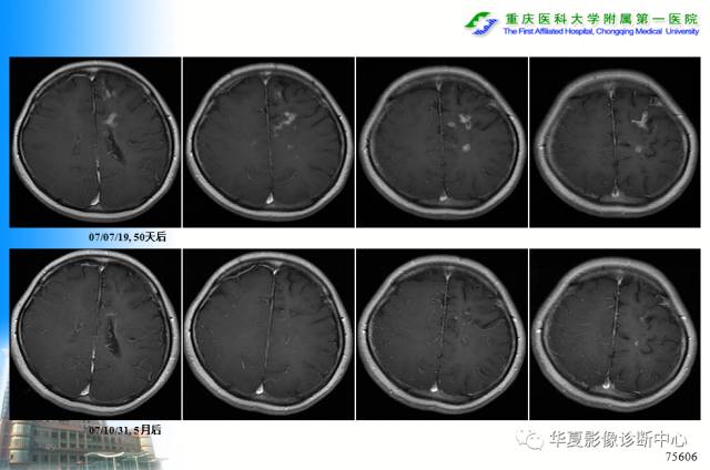 【PPT】自身免疫性脑病的影像学诊断