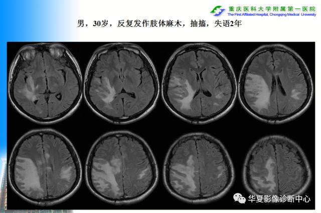 【PPT】自身免疫性脑病的影像学诊断