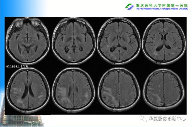 【PPT】自身免疫性脑病的影像学诊断