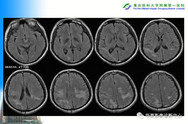 【PPT】自身免疫性脑病的影像学诊断