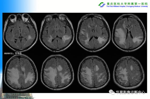 【PPT】自身免疫性脑病的影像学诊断