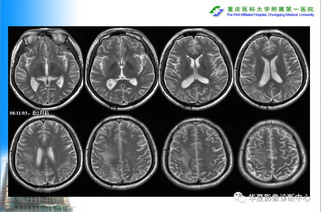 【PPT】自身免疫性脑病的影像学诊断