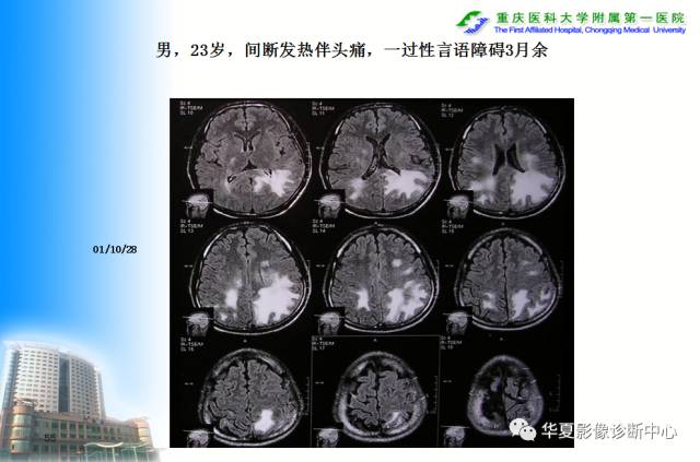 【PPT】自身免疫性脑病的影像学诊断
