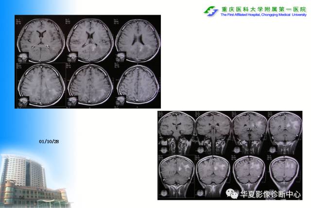 【PPT】自身免疫性脑病的影像学诊断