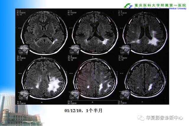 【PPT】自身免疫性脑病的影像学诊断