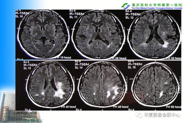 【PPT】自身免疫性脑病的影像学诊断