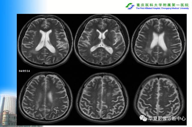 【PPT】自身免疫性脑病的影像学诊断