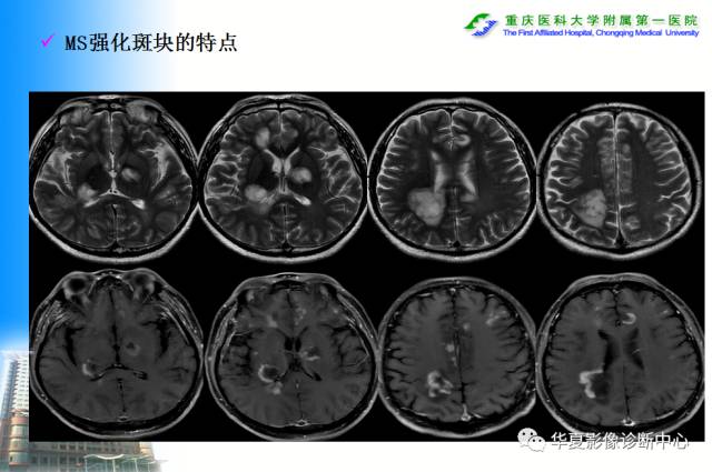 【PPT】自身免疫性脑病的影像学诊断