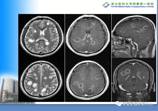 【PPT】自身免疫性脑病的影像学诊断