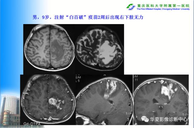 【PPT】自身免疫性脑病的影像学诊断
